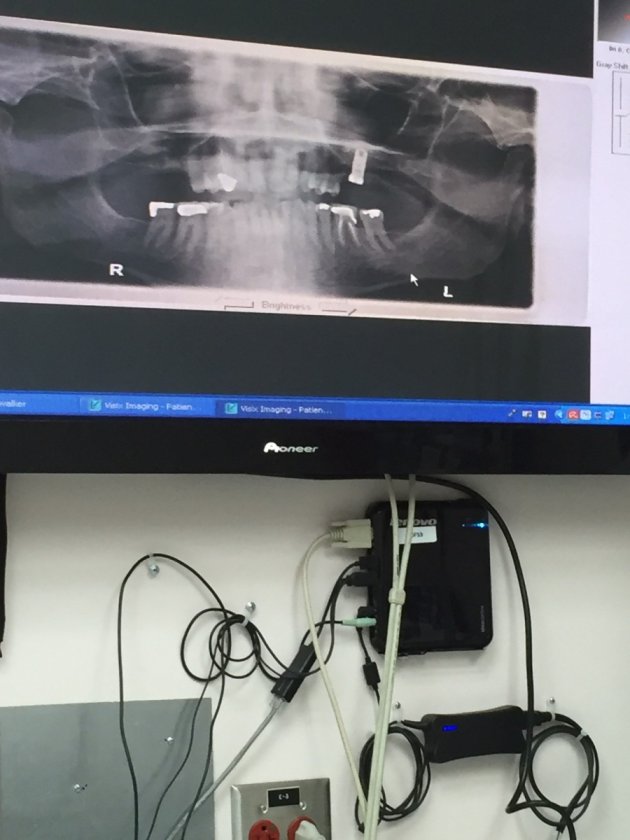 Broken Implant