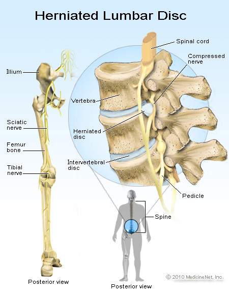 herniated-lumbar-disc